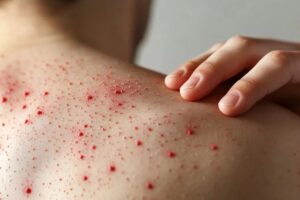 Van 92 casos acumulados de sarampión en Puebla 2 Van 92 casos acumulados de sarampión en Puebla