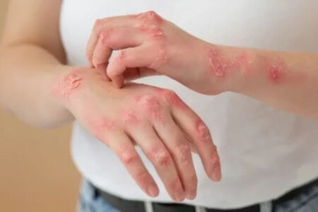 Puebla supera la barrera de los 100 casos de sarampión 14 Suman más de 100 casos de sarampión en Puebla