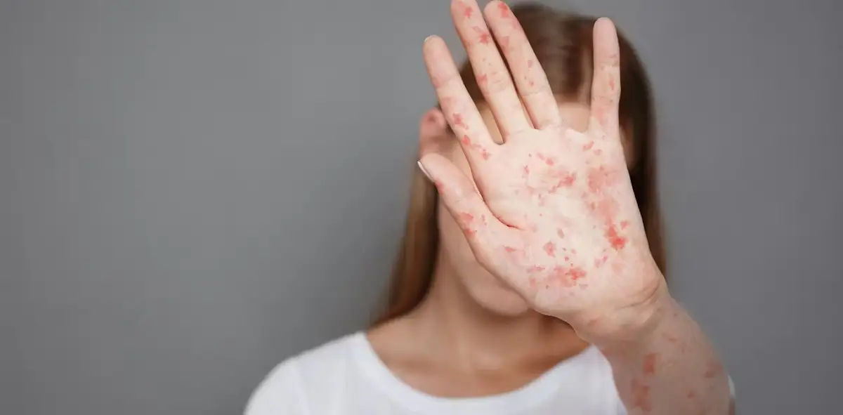 Puebla supera la barrera de los 100 casos de sarampión 2 Suman más de 100 casos de sarampión en Puebla