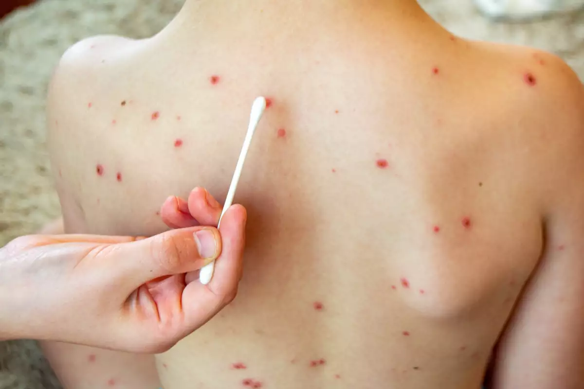 Vacunarán contra sarampión en paraderos de RUTA: ¿horarios, requisitos? 4 vacunas contra sarampión en paraderos de RUTA