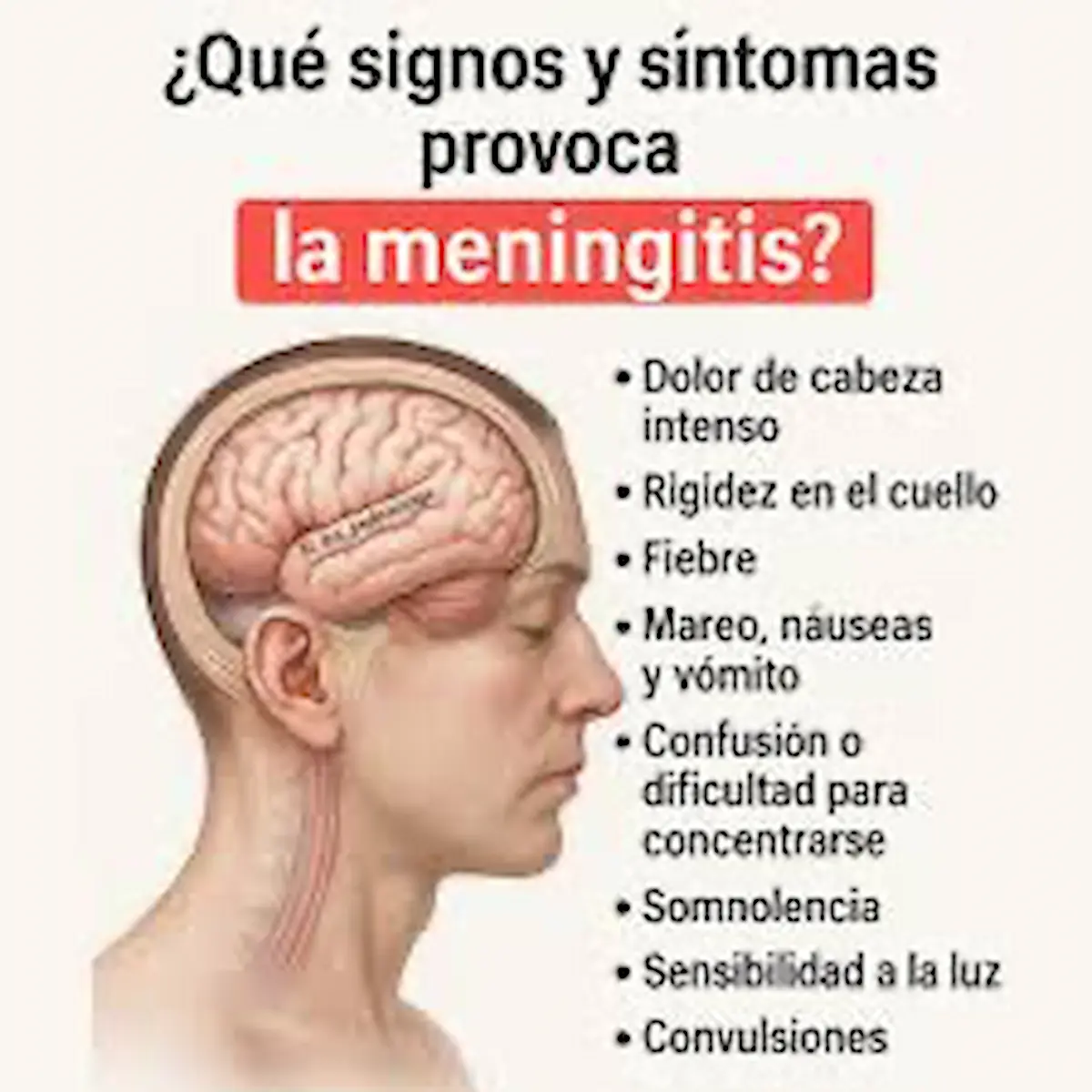 Qué es la meningitis y cuáles son los síntomas 
