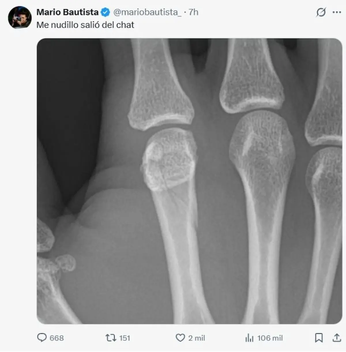 Cuál fue la lesión que sufrió Mario Bautista durante su pelea contra Aarón Mercury en Supernova?