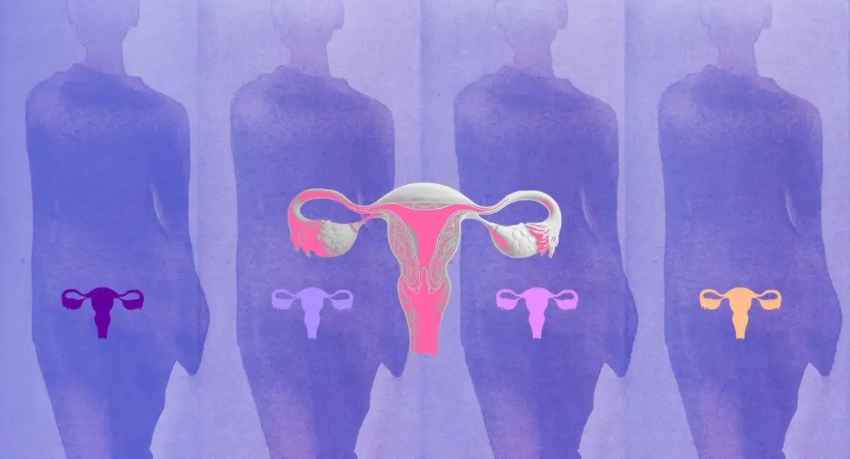¿Qué es el Síndrome Ovárico Metabólico Poliendocrino?