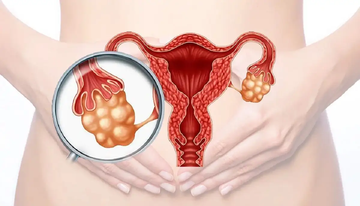 ¿Qué es el Síndrome Ovárico Metabólico Poliendocrino?