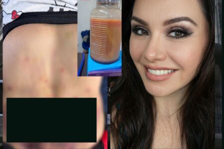 Surge nueva denuncia contra Diana Alejandra: Paciente casi pierde la vida por una mini Lipo en la Clínica Detox