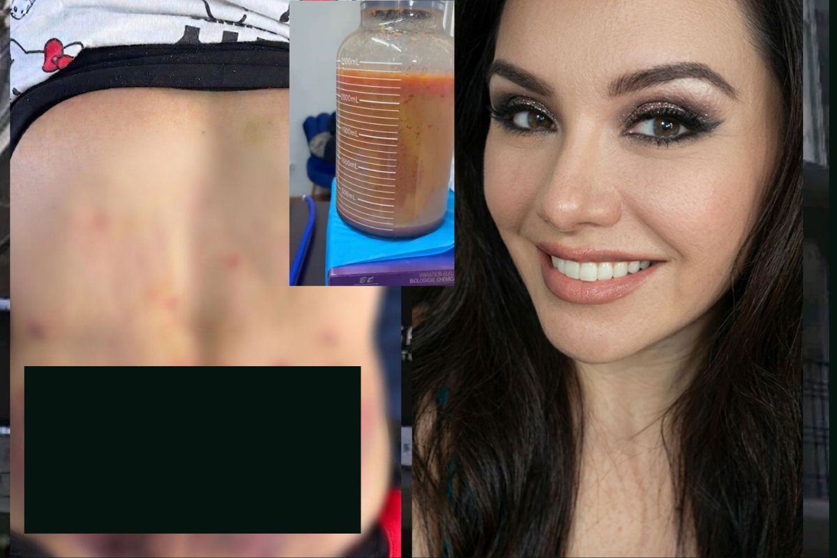 Surge nueva denuncia contra Diana Alejandra: Paciente casi pierde la vida por una mini Lipo en la Clínica Detox