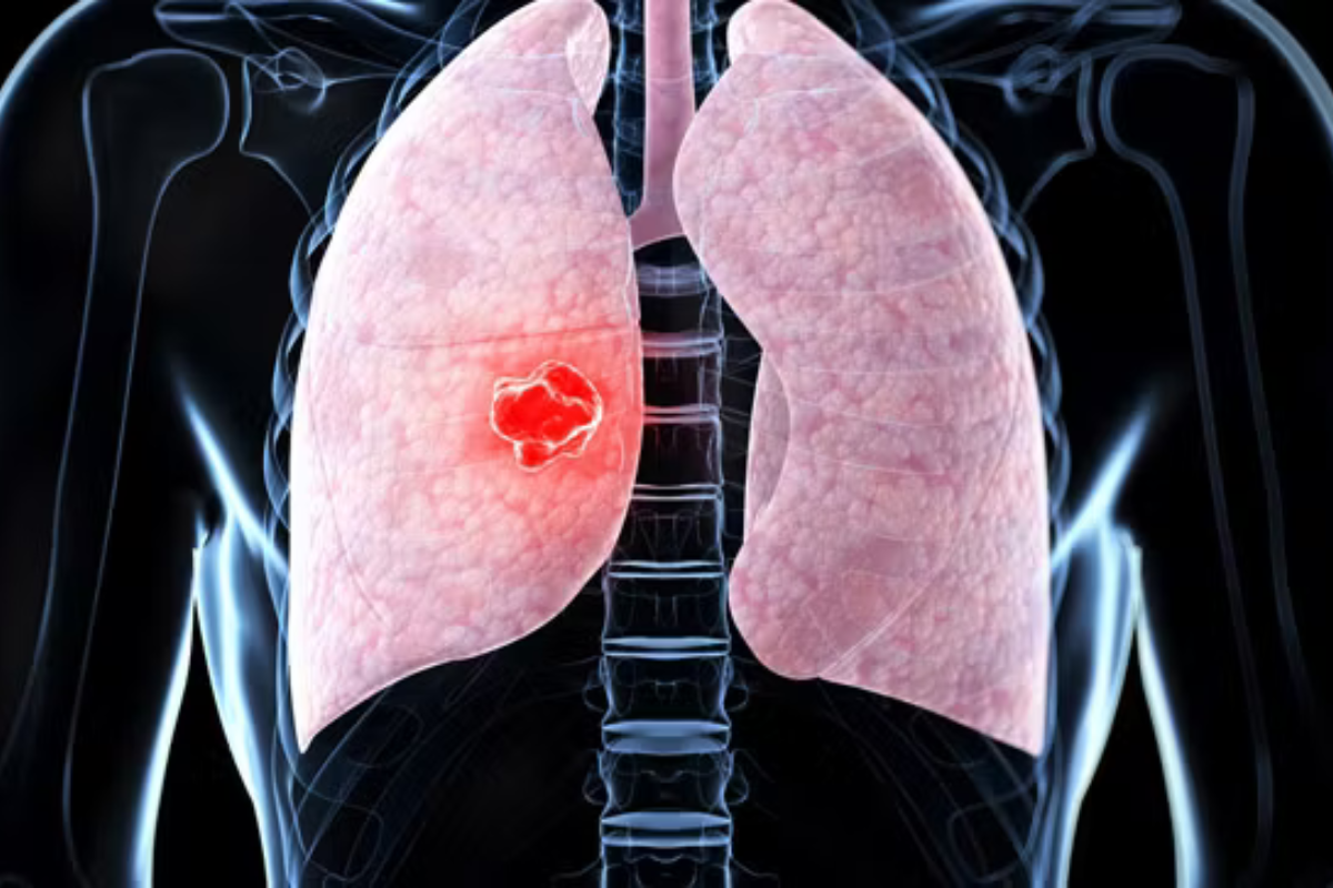 Papa León XIV será operado para extirpar un nódulo pulmonar